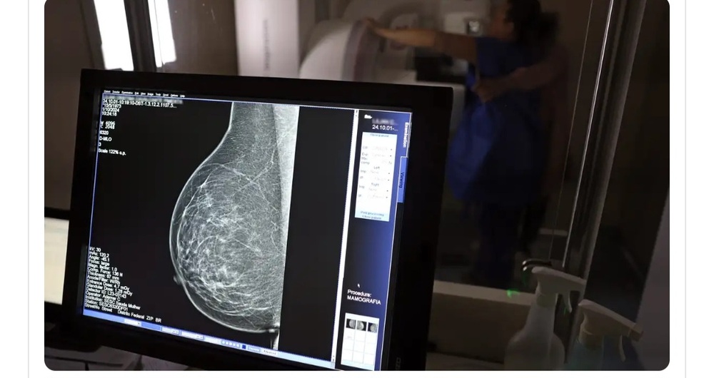 AGU processa médico que apontou mamografia como causadora de câncer