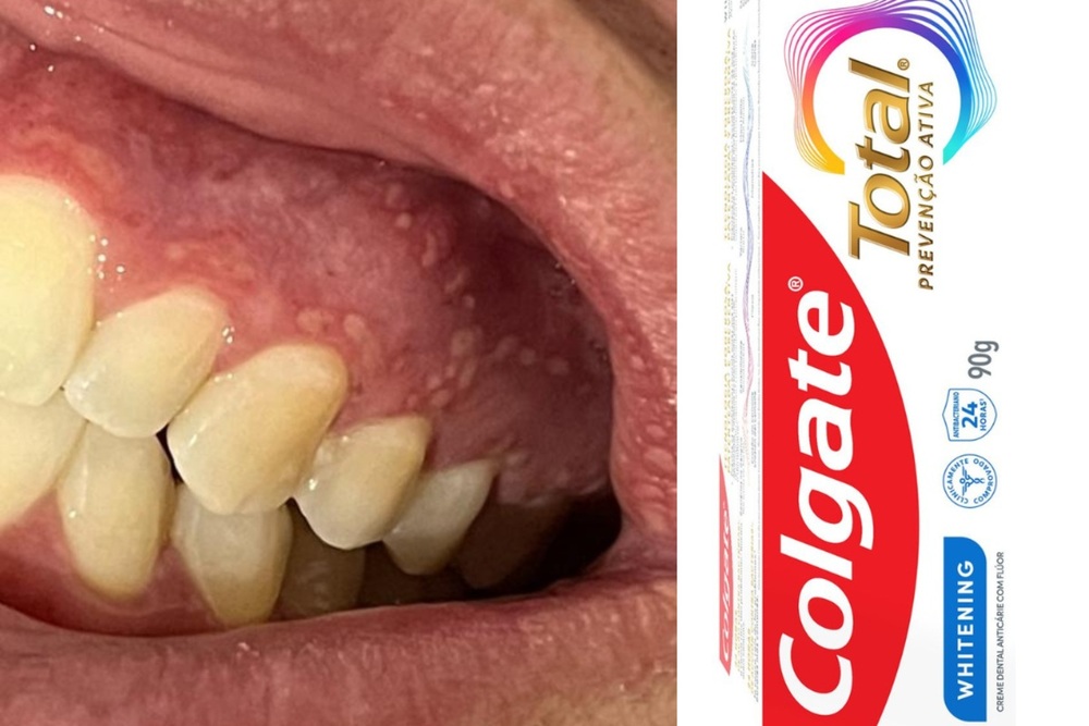 Anvisa interdita creme dental Colgate 'Clean Mint' por relatos de lesões bucais