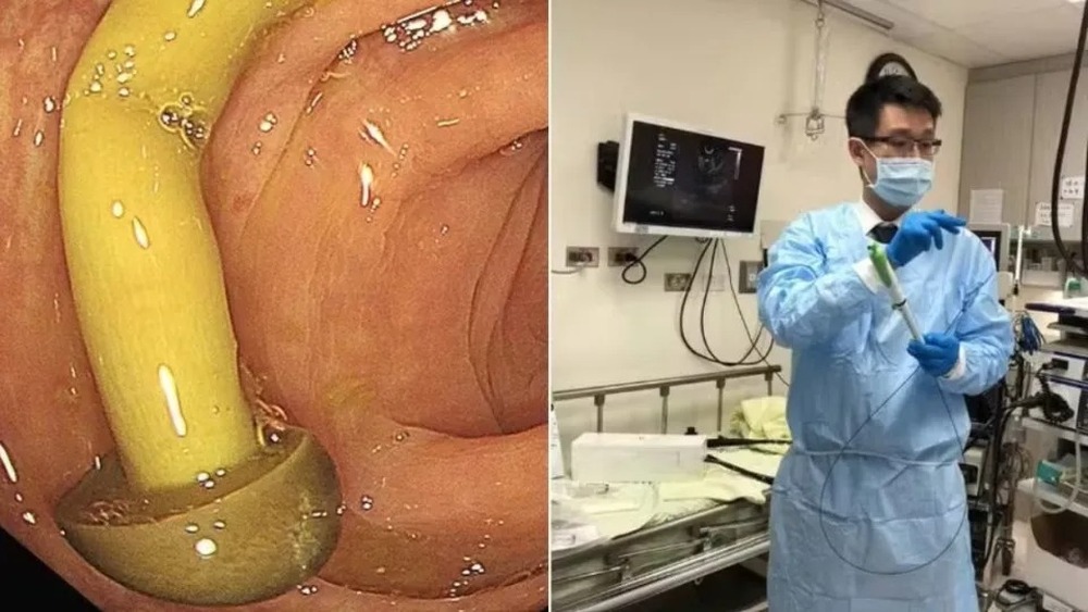 Médico descobre cogumelo crescendo no intestino de paciente