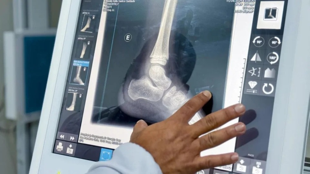 Amapá ampliou verba de emendas com número inflado de raio-X para 98% da população