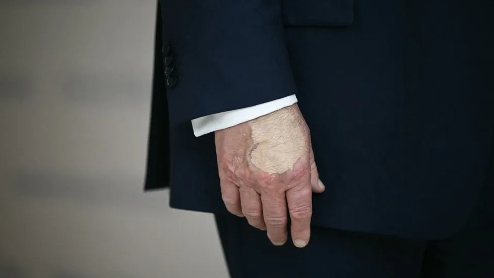 Trump volta a usar maquiagem na mão após diagnóstico