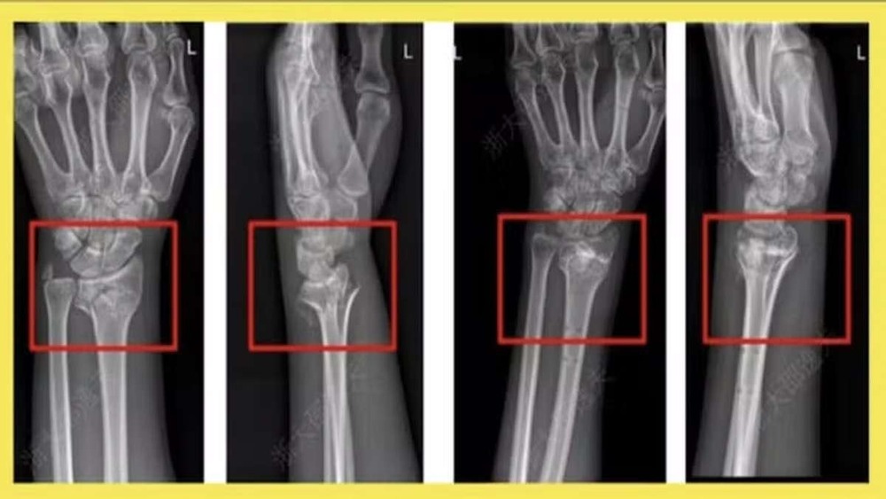 China cria supercola óssea inspirada em ostras que cura fraturas em minutos