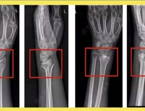 China cria supercola óssea inspirada em ostras que cura fraturas em minutos