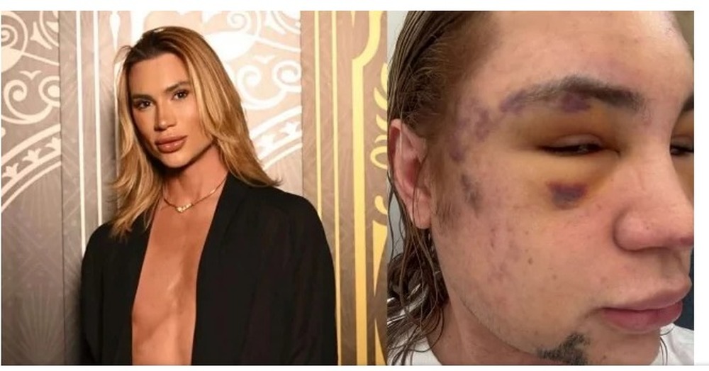 Morte de influenciador após procedimento estético reacende alerta