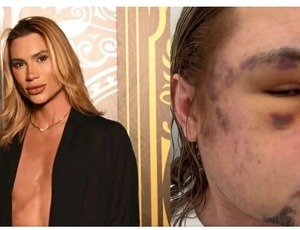 Morte de influenciador após procedimento estético reacende alerta