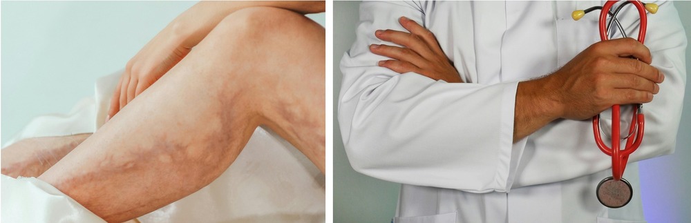 Doença que mata 100 mil pessoas  por ano no mundo tem encontro  internacional em São Paulo