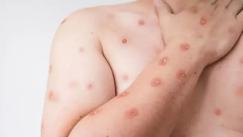 Brasil registra 48 casos de mpox nos primeiros meses de 2026