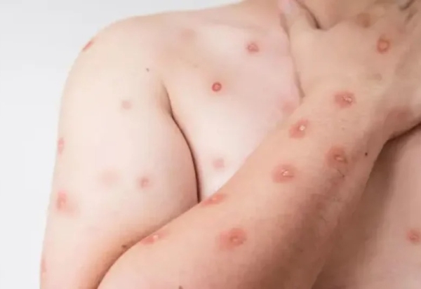 Brasil registra 48 casos de mpox nos primeiros meses de 2026