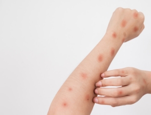 Brasil confirma aumento de casos de mpox em 2026 e autoridades reforçam vigilância