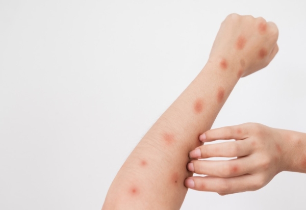 Brasil confirma aumento de casos de mpox em 2026 e autoridades reforçam vigilância