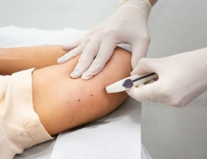 Itaguaí inicia oferta de implante contraceptivo Implanon pelo SUS