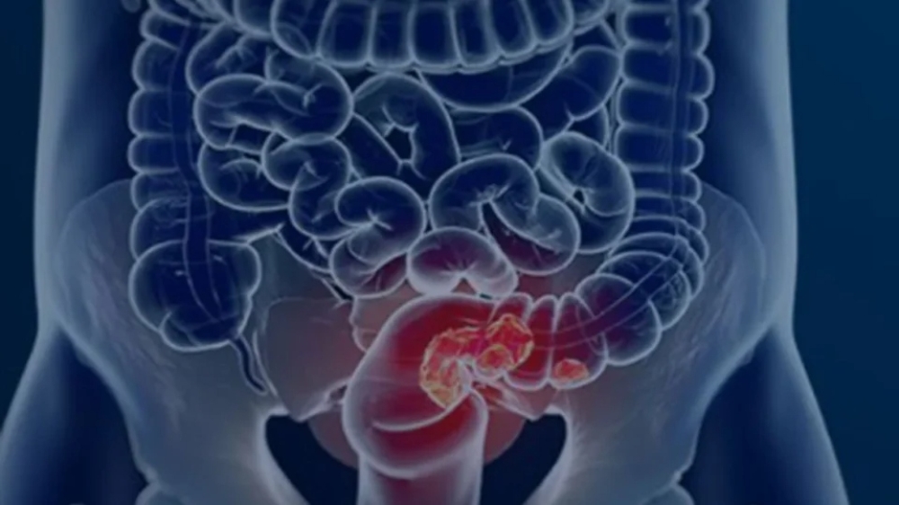 Veja seis sintomas que podem sinalizar o câncer de intestino em estágio inicial