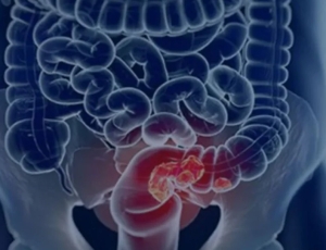 Veja seis sintomas que podem sinalizar o câncer de intestino em estágio inicial