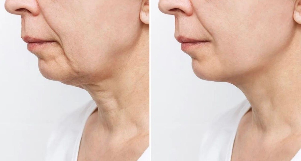 'Canetas de emagrecimento' exigem atenção: impacto na pele acende alerta entre especialistas