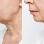 'Canetas de emagrecimento' exigem atenção: impacto na pele acende alerta entre especialistas