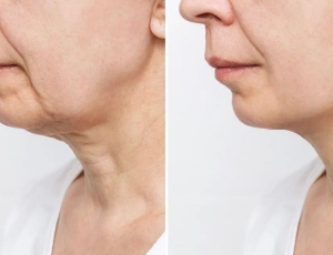 'Canetas de emagrecimento' exigem atenção: impacto na pele acende alerta entre especialistas