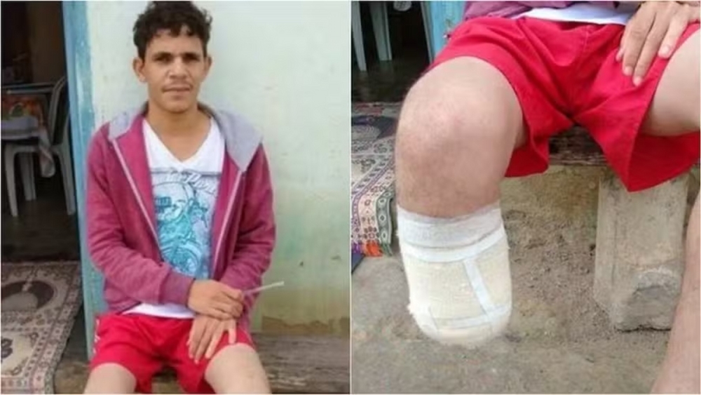 Servidor da Bahia amputou o próprio pé e o guardou na mochila para pedir R$ 1,5 milhão em seguros