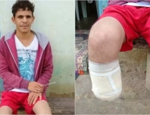 Servidor da Bahia amputou o próprio pé e o guardou na mochila para pedir R$ 1,5 milhão em seguros